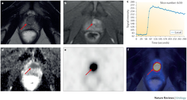 PSMA patienten scan